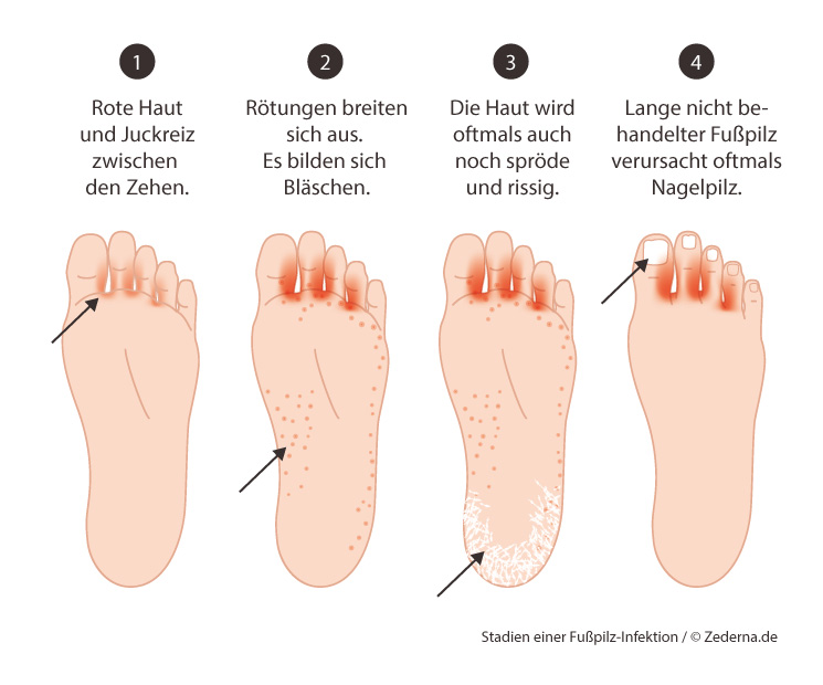 Was hilft gegen Fußpilz? Ursache, Symptome, Hausmittel gegen Fusspilz